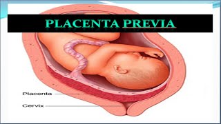 Learn OBGYN Third Trimester Bleeding and Abnormal Placentation [upl. by Akinej460]