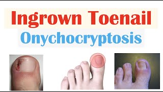 Ingrown Toenail Onychocryptosis  Causes Risk Factors Signs amp Symptoms Diagnosis Treatment [upl. by Cornela]