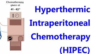 HYPERTHERMIC INTRAPERITONEAL CHEMOTHERAPY HIPEC For Mrcog part3 CaseDiscussionsMRCOGDrShabana [upl. by Silvan]