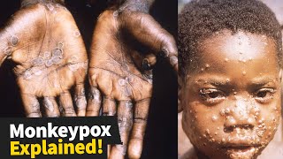 5 Things You Need to Know about Monkeypox Right Now [upl. by Ellek]