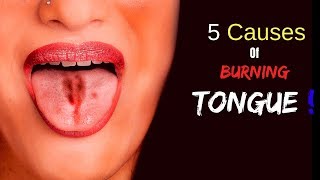 5 Common Causes of Burning Tongue [upl. by Demah]