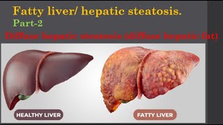 Fatty liver Diffuse hepatic steatosis diffuse hepatic fat [upl. by Hocker]