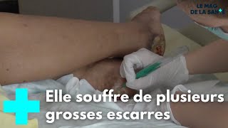 Comment soigner les escarres   Le Magazine de la Santé [upl. by Eiblehs805]