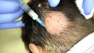 Intralesional corticosteroid injections for alopecia areata [upl. by Adnesor]