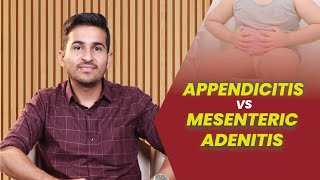 Appendicitis Vs Mesenteric Adenitis  Dr B Padam Kumar [upl. by Schulein]