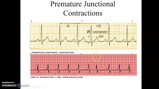 Junctional Rhythms and Premature Junctional Contractions [upl. by Cloots]