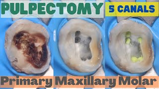 Pulpectomy ⚪️ PRIMARY MAXILLARY MOLAR 🟡 5 Canals 🔵 step by step demonstration [upl. by Blatt582]