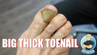 HOW TO TREAT YOUR BIG THICK RAMS HORN TOENAIL  FOOT HEALTH MONTH 2018 14 [upl. by Anitteb]