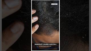 Dandruff Causes Hair Fall shorts viral dandruff [upl. by Peskoff]