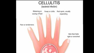 cellulitis infection on face [upl. by Assenay163]