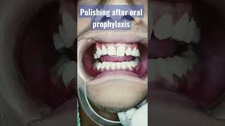 Detartrine polishing paste oral prophylaxis paste healthyteeth [upl. by Bertie869]