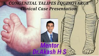 CONGENITAL TALIPES EQUINOVARUS Clinical Case Presentation [upl. by Garzon]