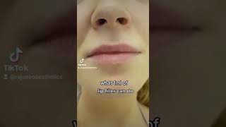 Lip filler 1ml transformation lipfiller lipfillers lipfillerbeforeandafter [upl. by Sucramed]