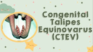 Congenital Talipes Equinovarus CTEV [upl. by Anirtap]