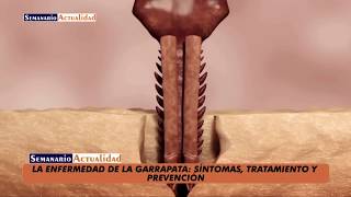 La enfermedad de la garrapata Síntomas tratamiento y prevención [upl. by Myranda429]