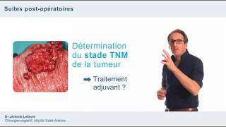 diagnostic du cancer du colon [upl. by Devad316]