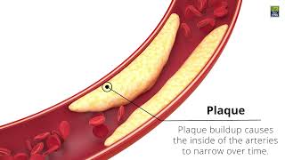 What is Angioplasty or PTCA Percutaneous Transluminal Coronary Angioplasty [upl. by Malanie772]