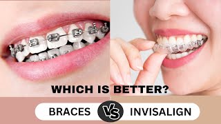 Braces vs Invisalign  How to choose between the two [upl. by Hna]