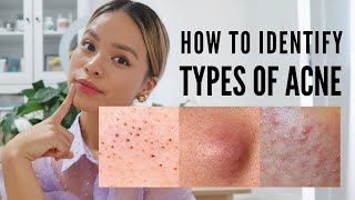 How to treat EVERY type of acne With Pictures [upl. by Muir]