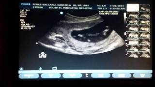 11 weeks and 3 days pregnant ultrasound [upl. by Yhtomit244]