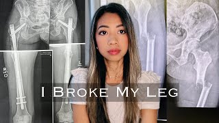 My 1 Year Recovery from Bilateral Femur Fixation Surgeries  Living with Stage 4 Cancer [upl. by Adnama]