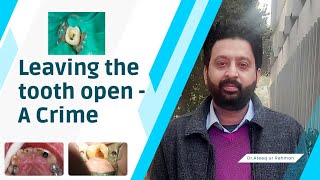 Leaving the tooth open in root canal treatment  ateeqdentalcare [upl. by Nea437]