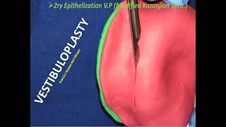 Preprosthetic Surgery 4 Vestibuloplasty [upl. by Castro770]