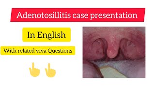 Adenotonsilitis case presentation  ENT  MBBS [upl. by Nnazus]