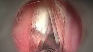 PHONOSURGERY  LEFT VOCAL FOLD PALSY [upl. by Anisah]