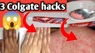 Colgate hacksacnegarmi danaygarmi ke dane ka ilajhow to cure baby rashes in diapers [upl. by Kaleena]