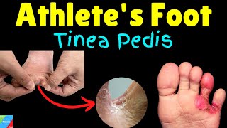 Athletes Foot Tinea pedis Symptoms Causes amp Treatment  Foot Fungus [upl. by Sherrill51]