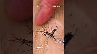 Removal of ingrown hair [upl. by Ailehpo475]