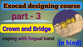 How to design lingual band in exocad  exocad crown design in hindi With Lingual Band [upl. by Eicyak690]