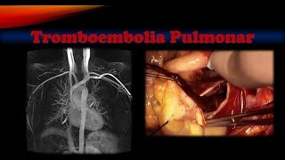 Tromboembolia pulmonar [upl. by Yetnom]