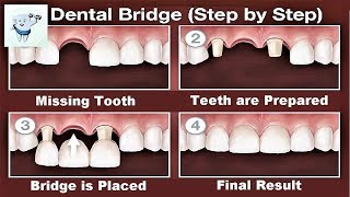 Dental Bridge Procedure Step by Step [upl. by Davidson991]