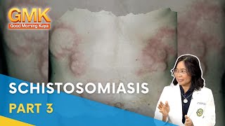 Schistosomiasis Causes Symptoms and Treatment Part 33  Usapang Pangkalusugan [upl. by Scarlet]