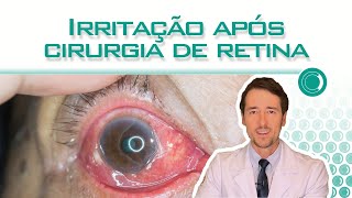 Irritação no olho após cirurgia de retina [upl. by Tillion]