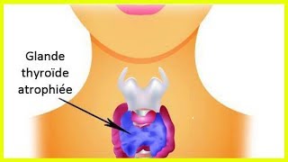 L’hypothyroïdie  comment prendre soin de sa thyroïde [upl. by Ulita]