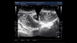 Uterine polyps also known as Endometrial polyps [upl. by Valle]