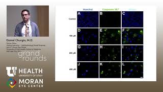 Proliferative Vitreoretinopathy [upl. by Ahsinav]