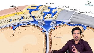 Epidural Hematoma Epidural hemorrhage Etiology Clinical features Diagnosis and Treatment [upl. by Suissac]