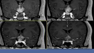 Preoperative Imaging  Germinoma  UCLA Pituitary Tumor Program [upl. by Yellas]