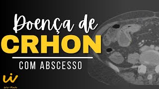 Doença de CRHON com Abscesso Retal [upl. by Aedrahs]