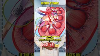 Severe KIDNEY STONE  पथरी pain कैसे होगा सही। kidneyfailure pain kidneystone [upl. by Elleral]