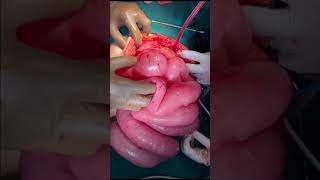 Single stage surgery for toxic megacolon [upl. by Nojram340]