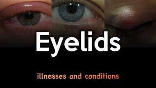 Eyelid Illnesses and Conditions [upl. by Levona130]