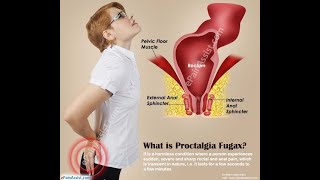 Proctalgia FUGAX 🔴ألم المستقيم العابر [upl. by Dearden]