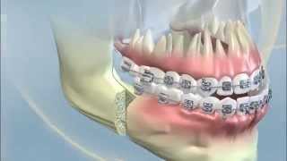 YORK ORTHODONTICS Orthognathic surgery class III [upl. by Etterraj]