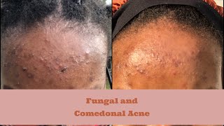 Clearing up my Fungal and Comedonal Forehead Acne  Skin Diary  Routine  Malassezia Folliculitis [upl. by Mullins]