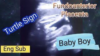 Fundoanterior placenta means baby boygirl  28 weeks pregnant  genderreveal scan  Turtle sign [upl. by Yarahs]